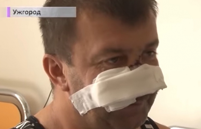 З болгарки зірвалась фреза: В Ужгороді зробили унікальну операцію, чоловіку врятували ніс та губу (ВІДЕО)