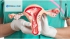 Лечение рака шейки матки в Испании